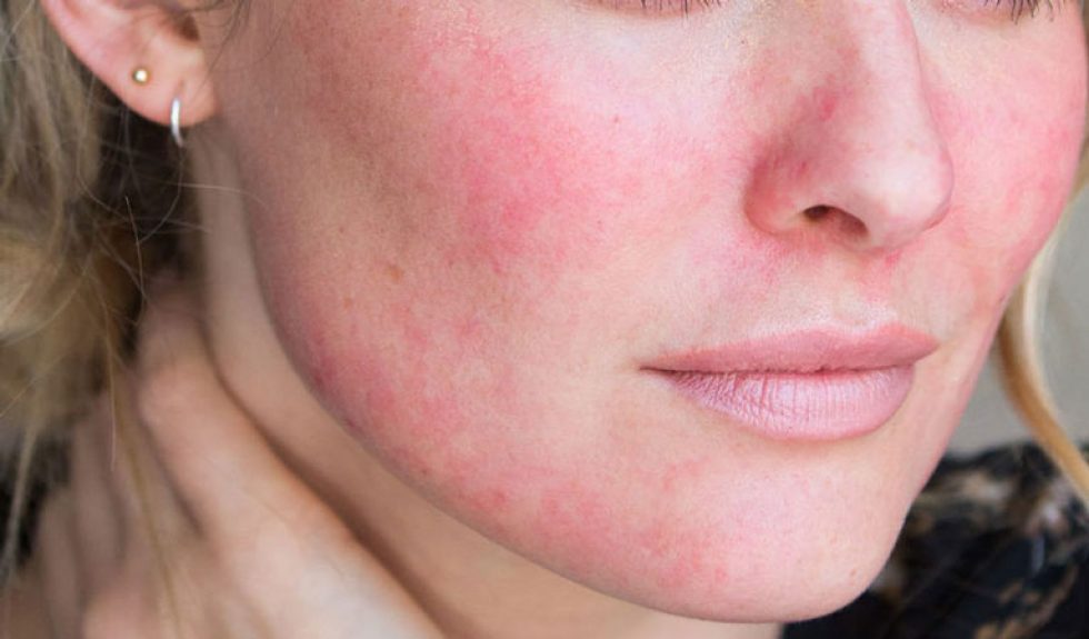 signs of rosacea