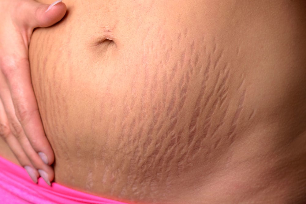 stretch marks on tummy