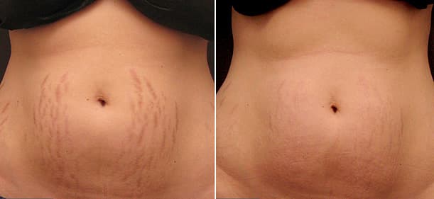 my results using stretch mark therapy